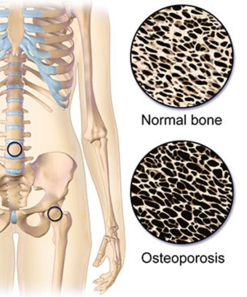 Osteoporosis DEXA Scan Results