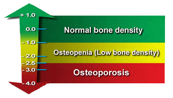 T-Scores for DEXA Bone Density Scan